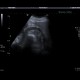 Complicated cyst, Bosniak III: US - Ultrasound